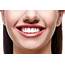 Teeth Whitening Milton  Dental Bleaching Treatment