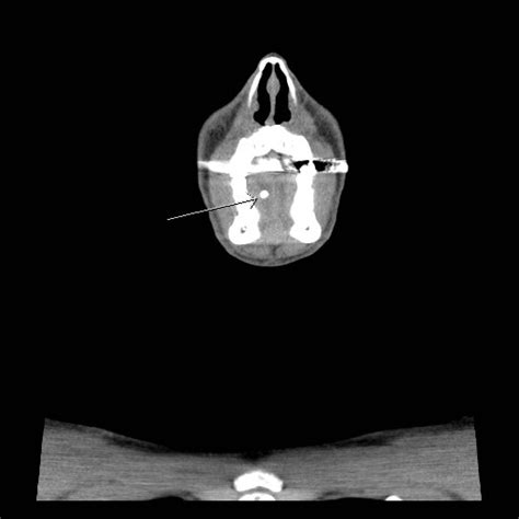 Acute Submandibular Sialadenitis Secondary To Ductal Stone Image