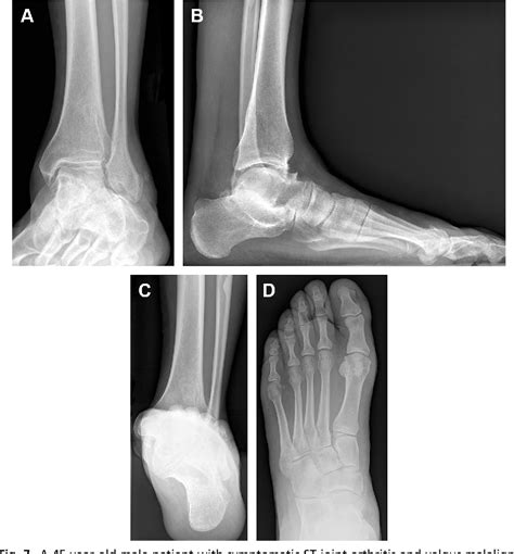 Figure 7 From Medial Approach To The Subtalar Joint Anatomy