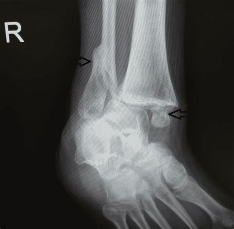 Cureus Surgical Intervention In Neglected Ankle Fracture A Case Report