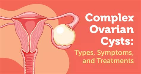 complex ovarian cysts types symptoms and treatments myovariancancerteam