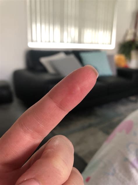 Identifying A Painful Bump On Finger Pad Thriftyfun
