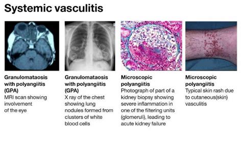 Vasculitis Institute Of Immunity And Transplantation Ucl