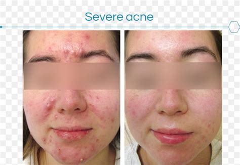 Acne Skin Face Dermatology Therapy Png 1385x954px Acne Acne