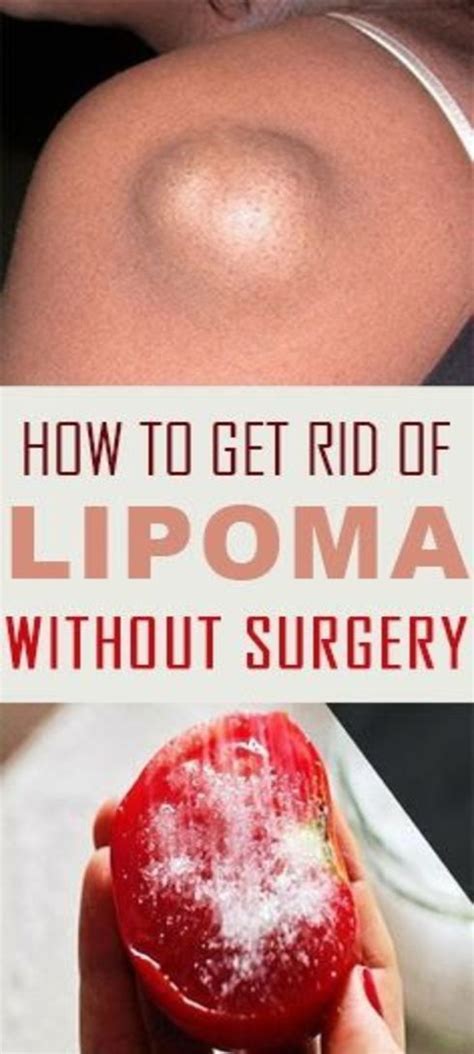 How To Get Rid Of Lipoma Without Surgery Wellness Days