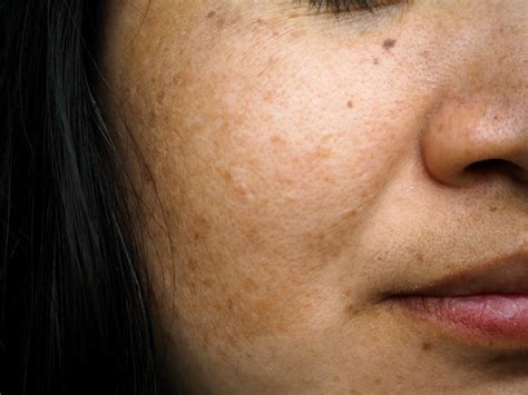 Melasma Wont Go Away After Pregnancy Heres What Experts Advise