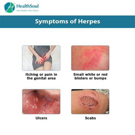 What You Need To Know About Herpes Or Hsv Healthsoul B F