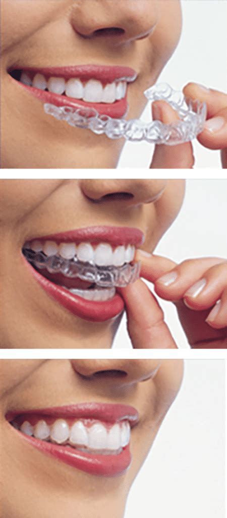 Invisalign Clear Braces In Mississauga Ontario