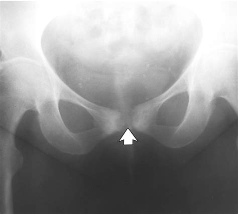 Symphyseal Cleft Injection In The Diagnosis And Treatment Of Osteitis