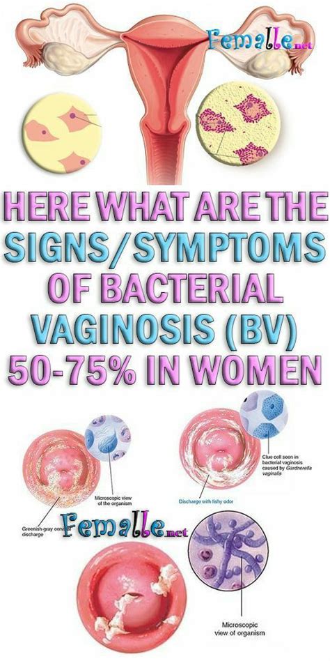 Pin By Rosa Padilla On Health In 2020 Bacterial Vaginosis Bacterial Vaginosis Treatment