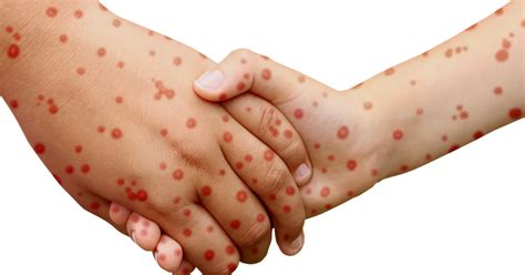 Is It Measles Signs And Symptoms Of Measles Activebeat Your Daily