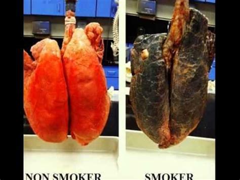 Maybe you would like to learn more about one of these? Perbedaan Rontgen Paru Paru Perokok Dan Bukan Perokok ...