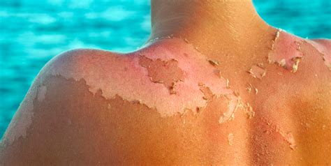 Sunburn Peeling How To Stop Sunburn Peeling Fast And Safely