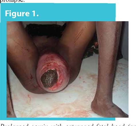 Figure 1 From Uterine Prolapse As An Unusual Cause Of Obstructed Labor