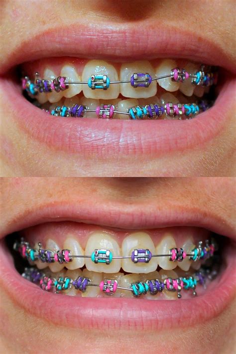 Pin By Jennifer B On Chaos Cute Braces Colors Cute Braces Dental Braces