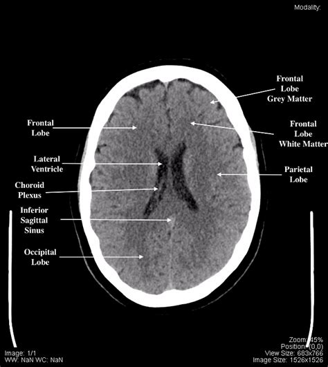 Ct Scan Tips Protocols Ct Brain Anatomy