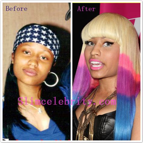 Nicki Minaj Before Surgery Celebrity Weight Loss And Celebrity Plastic Surgery
