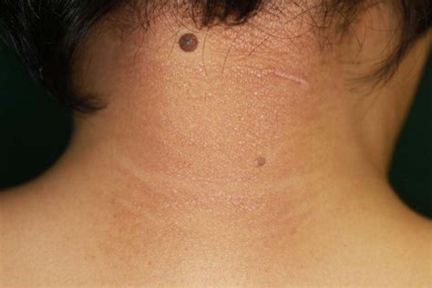 Clinical Appearance Of The Nape Of The Neck Three Months Later From The