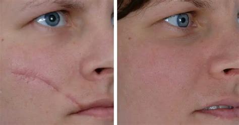 Remove Facial Scars With These 5 Home Remedies