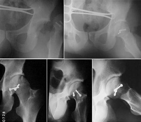 Intraoperative Dislocation Of The Left Hip Using The Watson Jones