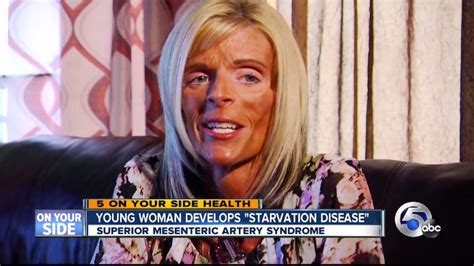 woman fights for her life against rare disorder starving her to death