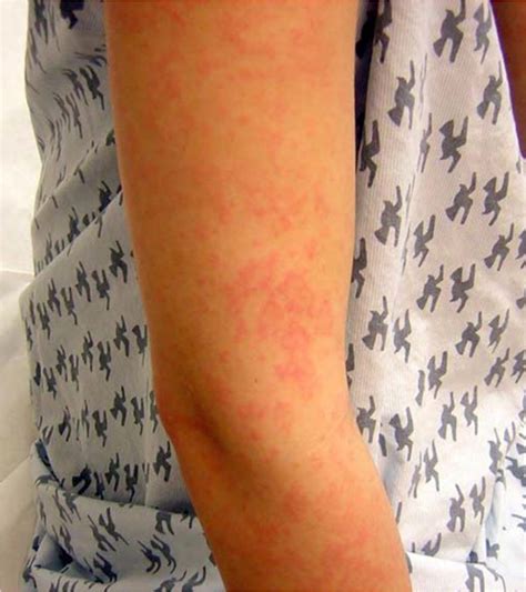 Erythema Multiforme Symptoms Pictures Causes Treatment Images