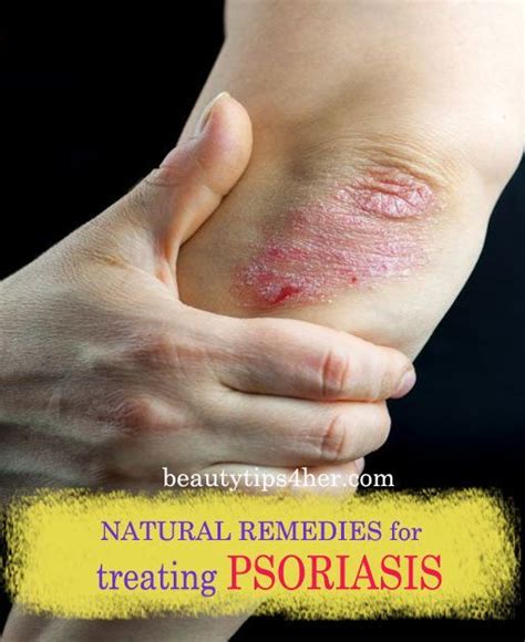 8 Natural Remedies For Treating Psoriasis Beauty And Makeup Tips