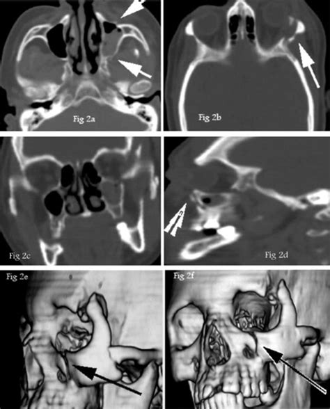 Left Zygomatico Maxillary Complex Fracture Case 1 A And B Non