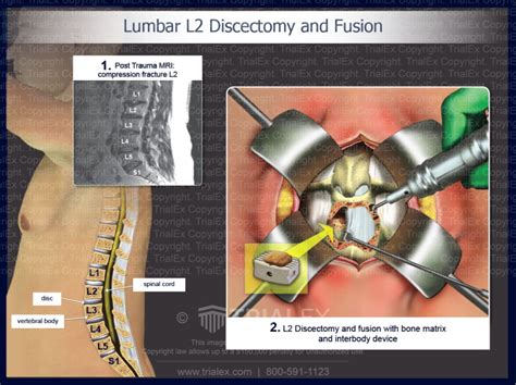 Lumbar L2 Discectomy And Fusion Trial Exhibits Inc