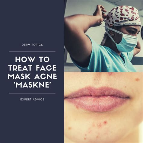 How To Treat Face Mask Acne Maskne Next Steps In Dermatology