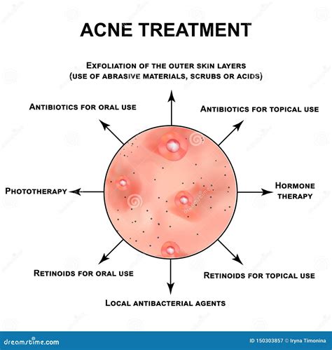 Acne Treatment Pustules Papules Comedones Blackheads Acne On The