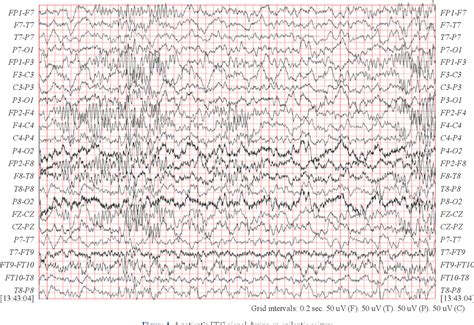 Figure 1 From Automatic Epileptic Seizure Detection Based On Eeg