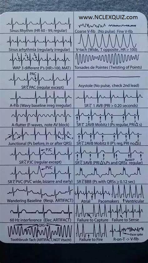 Acls Rhythm Strips Cheat Sheet