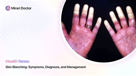 Skin Blanching Symptoms Diagnosis And Management