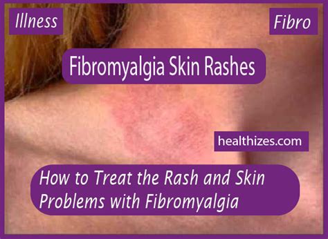 How To Treat Rash And Skin Problems With Fibromyalgia Treatments