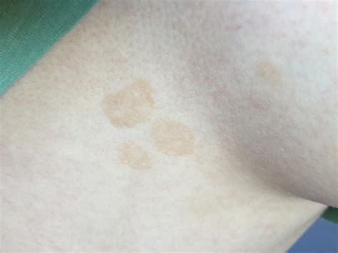 Advantage Spit Guidelines Dark Spots On Breast Skin Evaluate Lake Taupo
