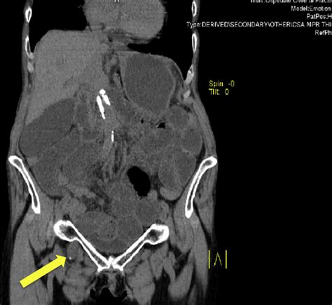 Ct Scan Sagittal Section Right Obturator Hernia Download