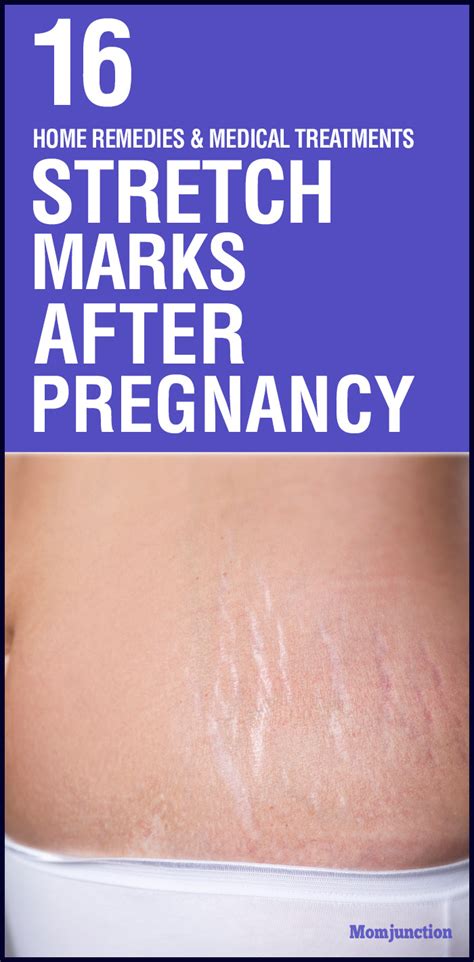 How to hide a pregnancy: How To Remove Stretch Marks After Pregnancy: 16 Home Remedies