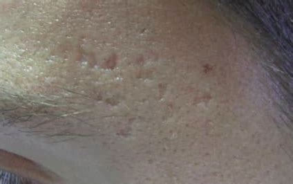 Cicatrici De Acnee Clasificare Si Optiuni De Tratament Skin Clinic