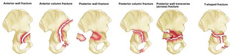 Classification Of Acetabular Fractures My Xxx Hot Girl