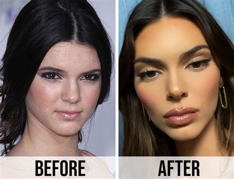 These Before And After Pics Of Kendall Jenner Are Insane—what Did She Do To Her Lips Shefinds