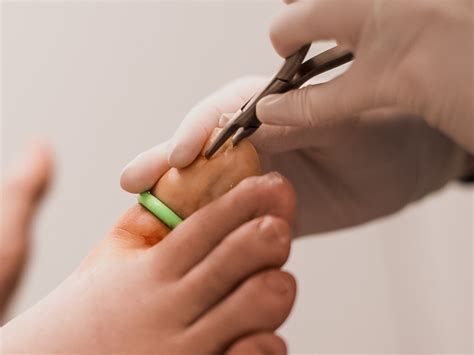 Ingrown Nail Surgery In Penrith Ryde And Other Areas
