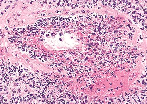 Pathology Outlines Granulomatosis With Polyangiitis Gpa