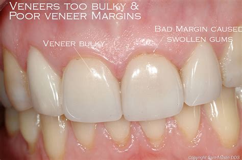 Top 7 Worst Veneers Before And After 2022