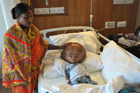 I've got lots of,life to live and i'm hoping you'll be down for the ride. Roona Begum, Indian Girl With Severe Hydrocephalus To Have ...