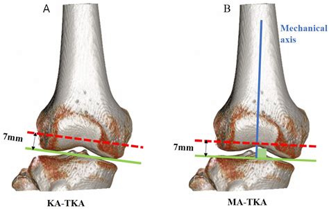 Distal Femur Anatomy My Xxx Hot Girl