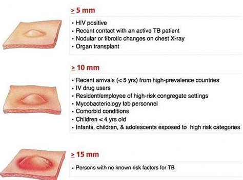 Tuberculin Skin Test Positive Mantoux Test Result Reading And