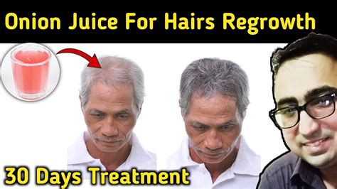 Does Onion Juice Help Hair Loss A Look At The Science Pharmacist