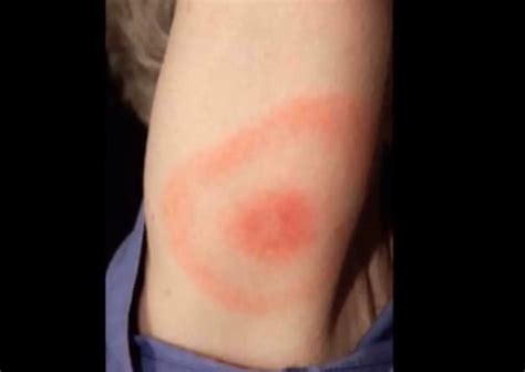 Brown Recluse Bite Pictures Stages Signs Treatment Youmemindbody