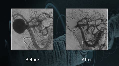 Video Complex Splenic Aneurysm Embolization By Stent Assisted Coiling